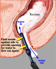 rinsing out rectum