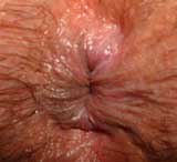Photo of anus (external)