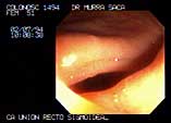 Video of rectal valves