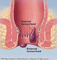 Hemorrhoids