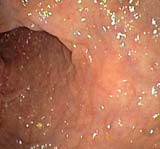 Photo of rectum wall