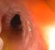 Rectal valve opening