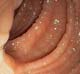 Rectal valve open
