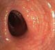 Rectal valve open