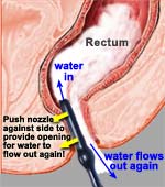 rinsing out rectum