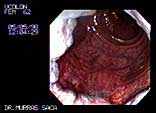 Video of rectum